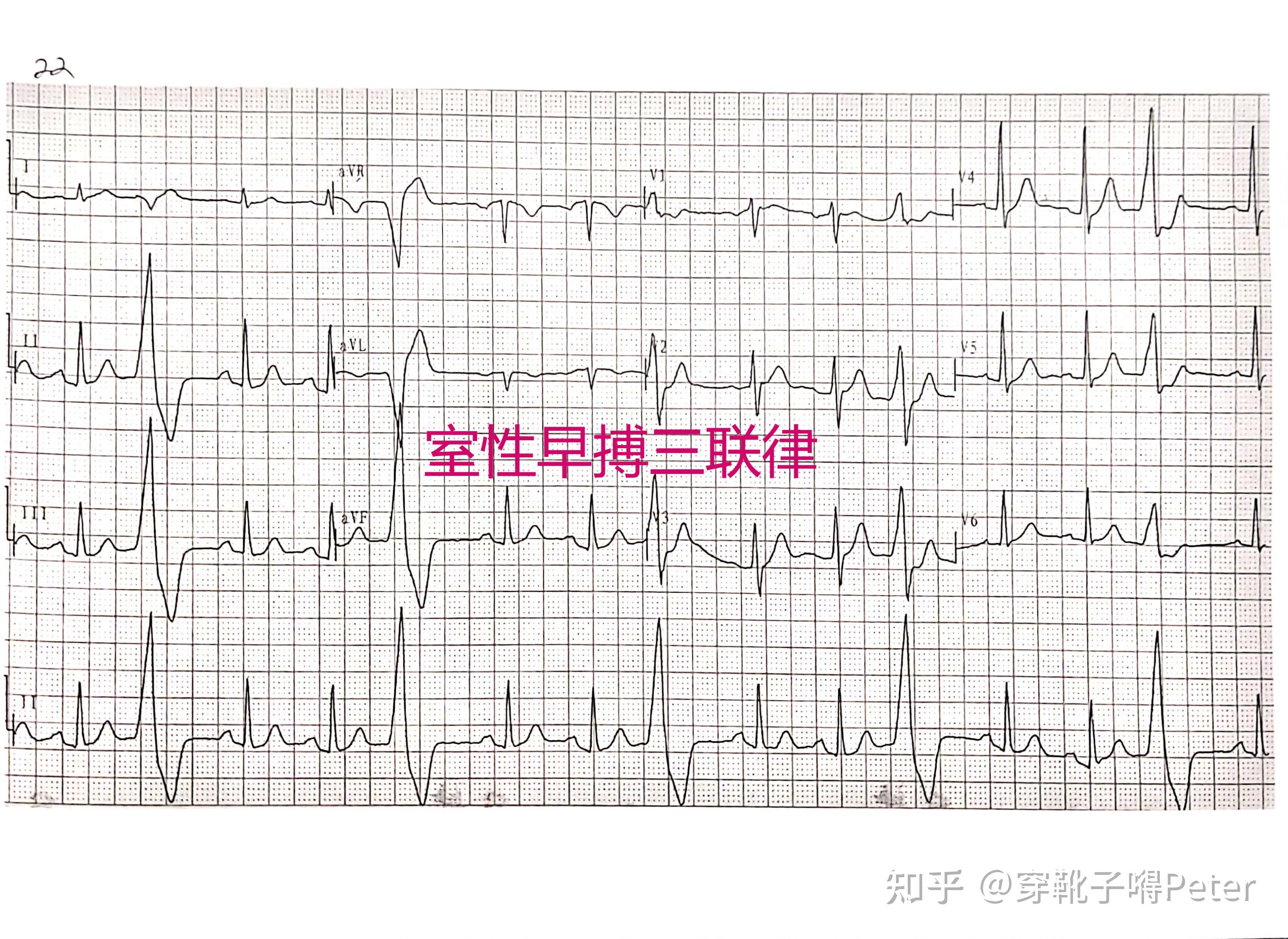 钙依赖性钾通道是什么_第三类钾通道阻滞剂_钾通道阻滞剂有哪些药